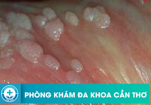 Phòng ngừa vùng da bao quy đầu nổi mụn trắng thế nào?