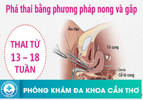 Phương pháp nong và gắp thai