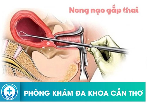 Phương pháp nong - nạo gắp thai