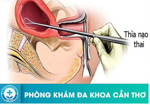 Phương pháp nong và nạo thai 