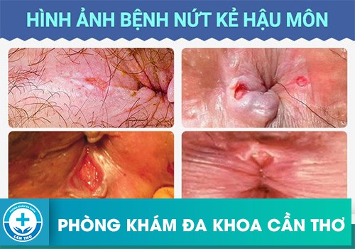 Nứt hậu môn cấp tính và nứt hậu môn mãn tính là gì?