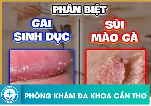 Gai sinh dục và sùi mào gà có tính chất khá tương đồng nên rất dễ bị nhầm lẫn