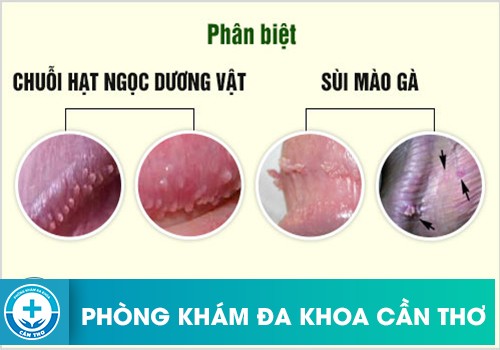 Sùi mào gà gây ra nhiều biến chứng nguy hiểm cho người bệnh 