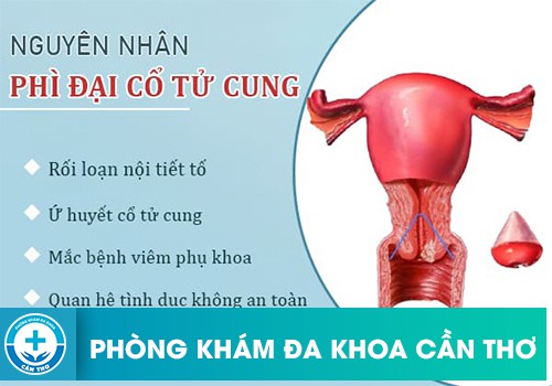 Nguyên nhân dẫn đến phì đại cổ tử cung