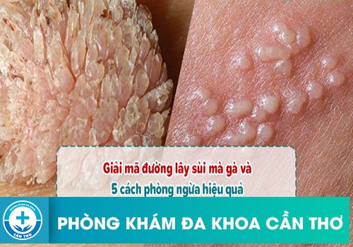 Những cách phòng ngừa sùi mào gà hiệu quả