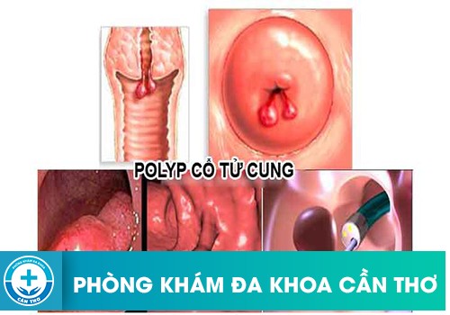 Làm thế nào để nhận biết xoắn polyp cổ tử cung khi mang thai