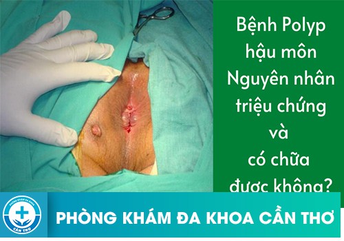 Polyp hậu môn là bệnh gì?