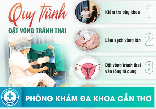 Quy trình đặt vòng tránh thai an toàn