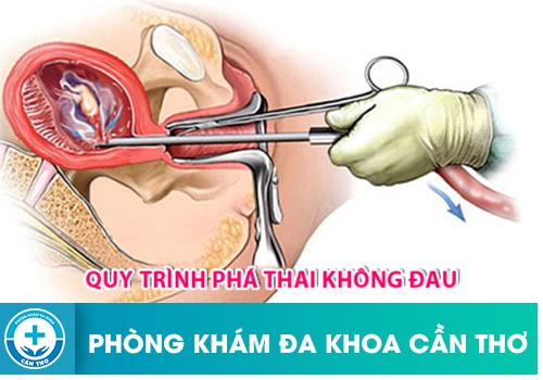 Quy trình thực hiện phá thai không đau bằng phương pháp trực quan siêu dẫn 