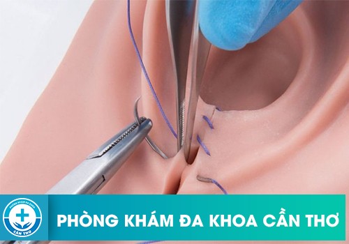 Vá Màng Trinh Có Dẫn Đến Sẹo Hay Không