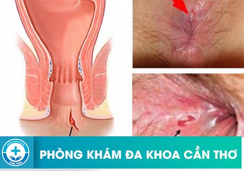 Tại sao lại bị rách hậu môn?