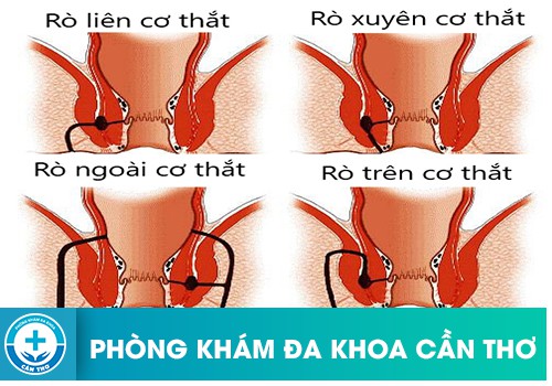 Hình ảnh bệnh rò hậu môn