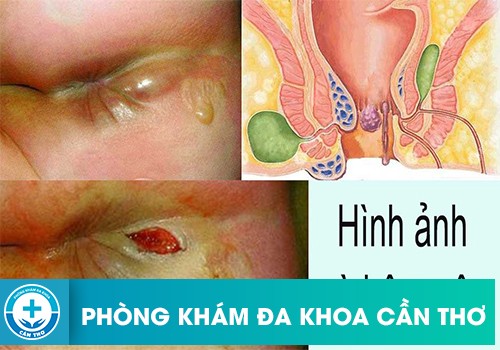 4 Biểu Hiện Chính Của Bệnh Rò Hậu Môn