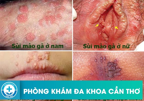 ⚕️ Dấu Hiệu Nhận Biết Sùi Mào Gà Dễ Nhất