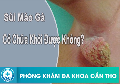 sui mao ga co the dieu tri khoi han duoc hay khong