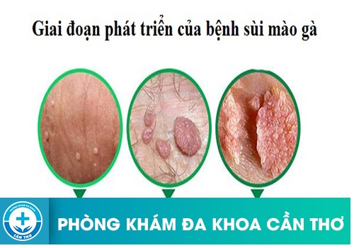 Sùi Mào Gà Phát Triển Có Nhanh Không?