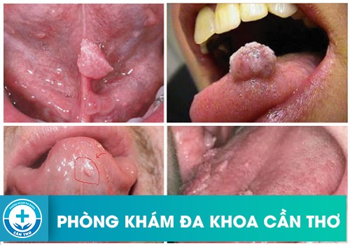 Sùi mào gà ở lưỡi khám ở đâu Cần Thơ