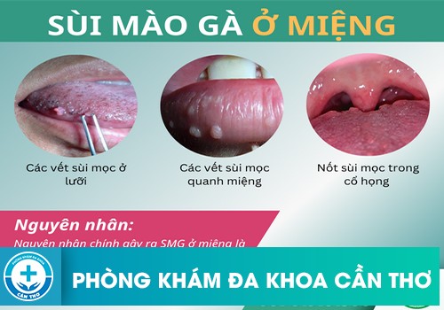 Sùi Mào Gà Ở Miệng Có Đau Không?