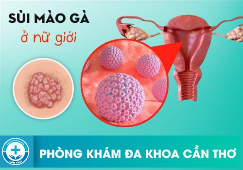 Thế nào là bệnh sùi mào gà nữ?