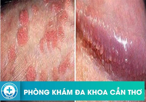 Phân Biệt Sùi Mào Gà Và Chuỗi Hạt Ngọc Dương Vật