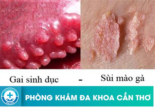 Sự Khác Nhau Giữa Gai Sinh Dục Và Sùi Mào Gà