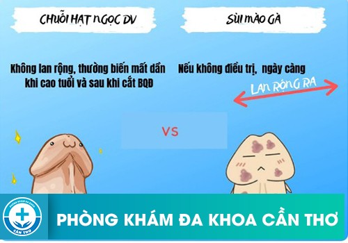 Hình ảnh sùi mào gà và chuỗi hạt ngọc dương vật