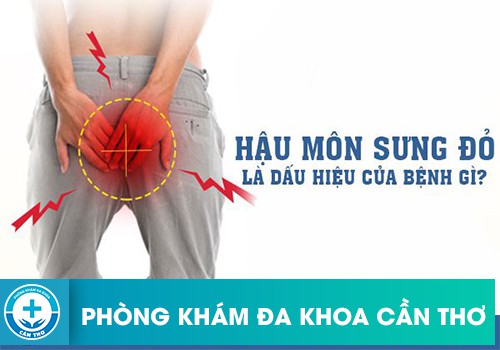 Sưng hậu môn biểu hiện của nhiều căn bệnh nguy hiểm