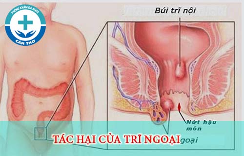 Tác hại của trĩ ngoại