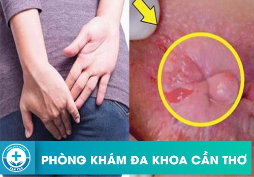 Hậu môn có thịt dư không đau là bị gì và có nguy hiểm không