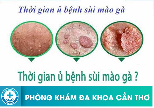 Thời Gian Ủ Bệnh Của Bệnh Sùi Mào Gà Trong Bao Lâu?