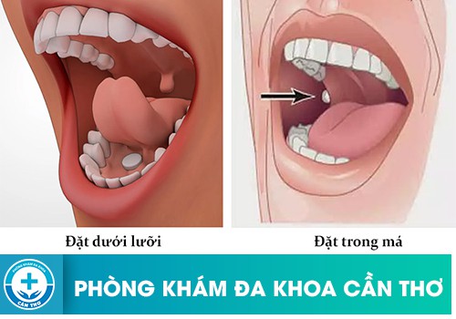 Nên Chọn Thuốc Phá Thai Dạng Ngậm Hay Thuốc Phá Thai Dạng Đặt