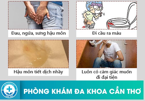 Dấu Hiệu Ngứa Hậu Môn Có Phải Là Dấu Hiệu Bệnh Trĩ