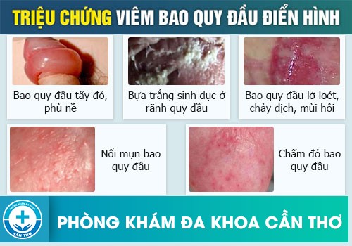 Dấu hiệu nhận biết viêm bao quy đầu ở nam