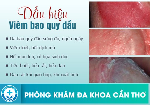 Dấu hiệu viêm bao quy đầu