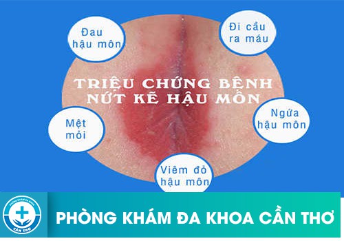 Bệnh nứt hậu môn cấp tính và mãn tính có những dấu hiệu gì?