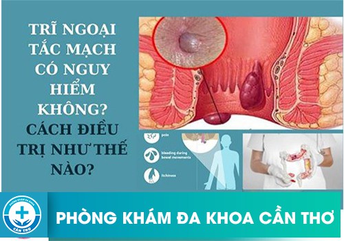 Bệnh trĩ ngoại tắc mạch có nguy hiểm không