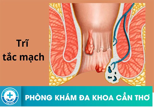 ⚕️ Trĩ Ngoại Tắc Mạch Là Gì Và Có Nguy Hiểm Không?