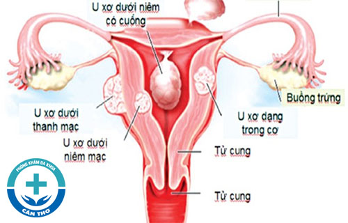 U xơ cổ tử cung là bệnh gì điều trị như thế nào hiệu quả?