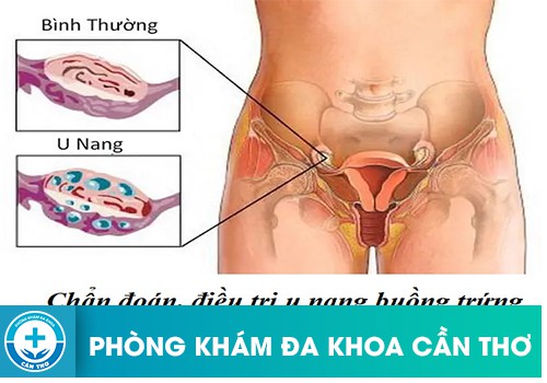 U nang buồng trứng là bao nang chứa đầy dịch, hình thành trong buồng trứng của người phụ nữ