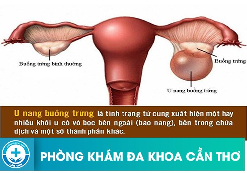 Nguyên nhân gây u nang buồng trứng ở nữ