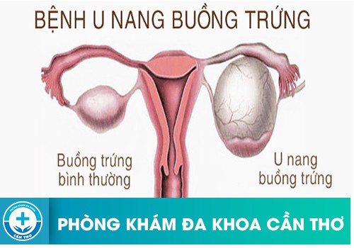 Vỡ nang buồng trứng là gì?