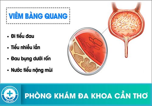 Triệu Chứng Nhận Biết Bệnh Viêm Bàng Quang