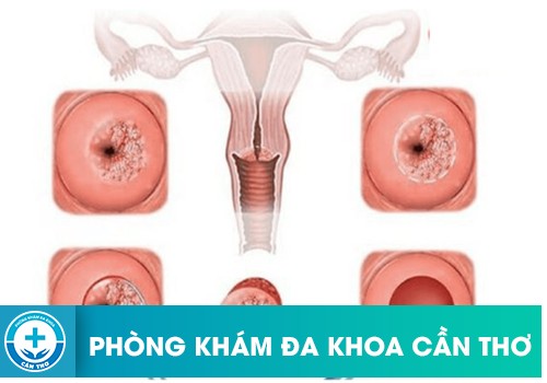 Vùng Kín Ra Nhiều Dịch Màu Vàng Có Mùi Hôi Khó Chịu Là Bệnh Gì?