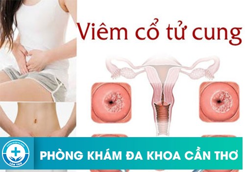 Viêm Nhẹ Cổ Tử Cung Là Như Thế Nào?