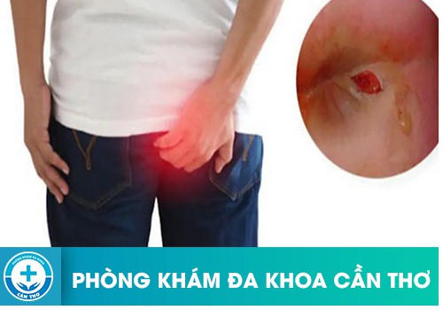 Viêm loét ống hậu môn có gây ra ung thư trực tràng hay không?