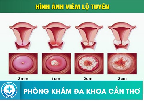  Viêm lộ tuyến cổ tử cung 2cm