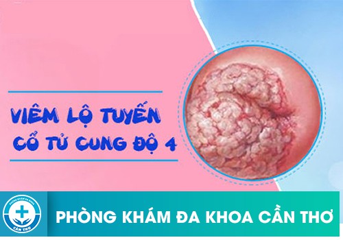 nhung bien chung nguy hiem cua viem lo tuyen co tu cung do 4