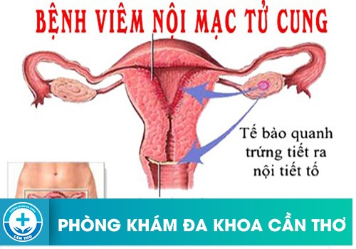 Viêm Niêm Mạc Cổ Tử Cung Nguyên Nhân Và Cách Điều Trị