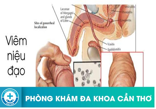 Bệnh viêm niệu đạo ở nam giới