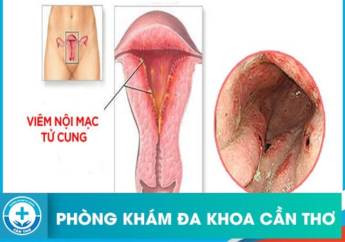 Viêm niêm mạc tử cung là gì?